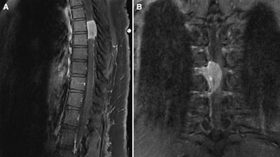 Intradural extramedullary spinal cord meningioma with a rare extradural foraminal extension: A case report